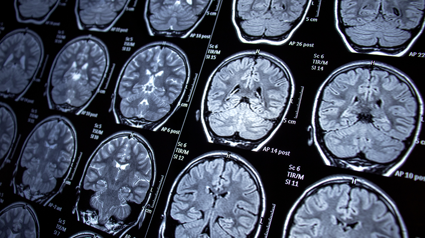 Magnetic resonance imaging of a brain